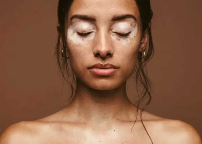 Vitilinox: A Complete Guide to Understanding This Popular Skin Health Solution