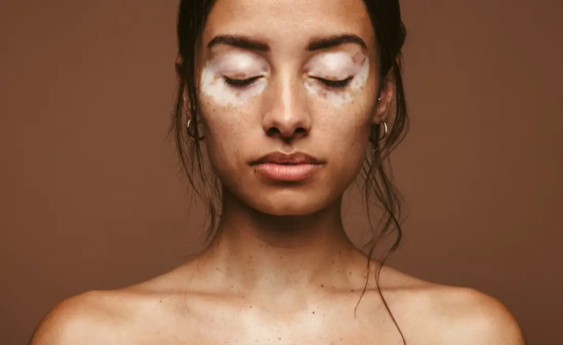 Vitilinox: A Complete Guide to Understanding This Popular Skin Health Solution